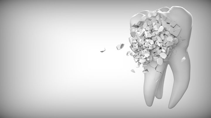 Was tun gegen Schmerzen durch einen gebrochenen Zahn?